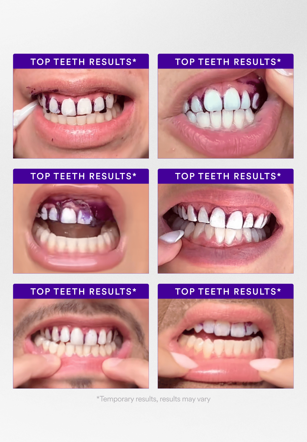 Smyle® Purple Whitening Strips