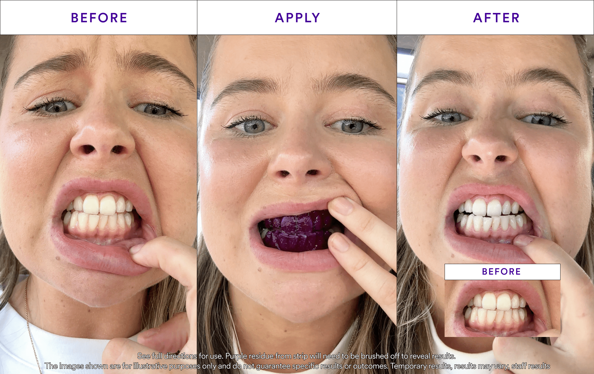 Smyle® Purple Whitening Strips